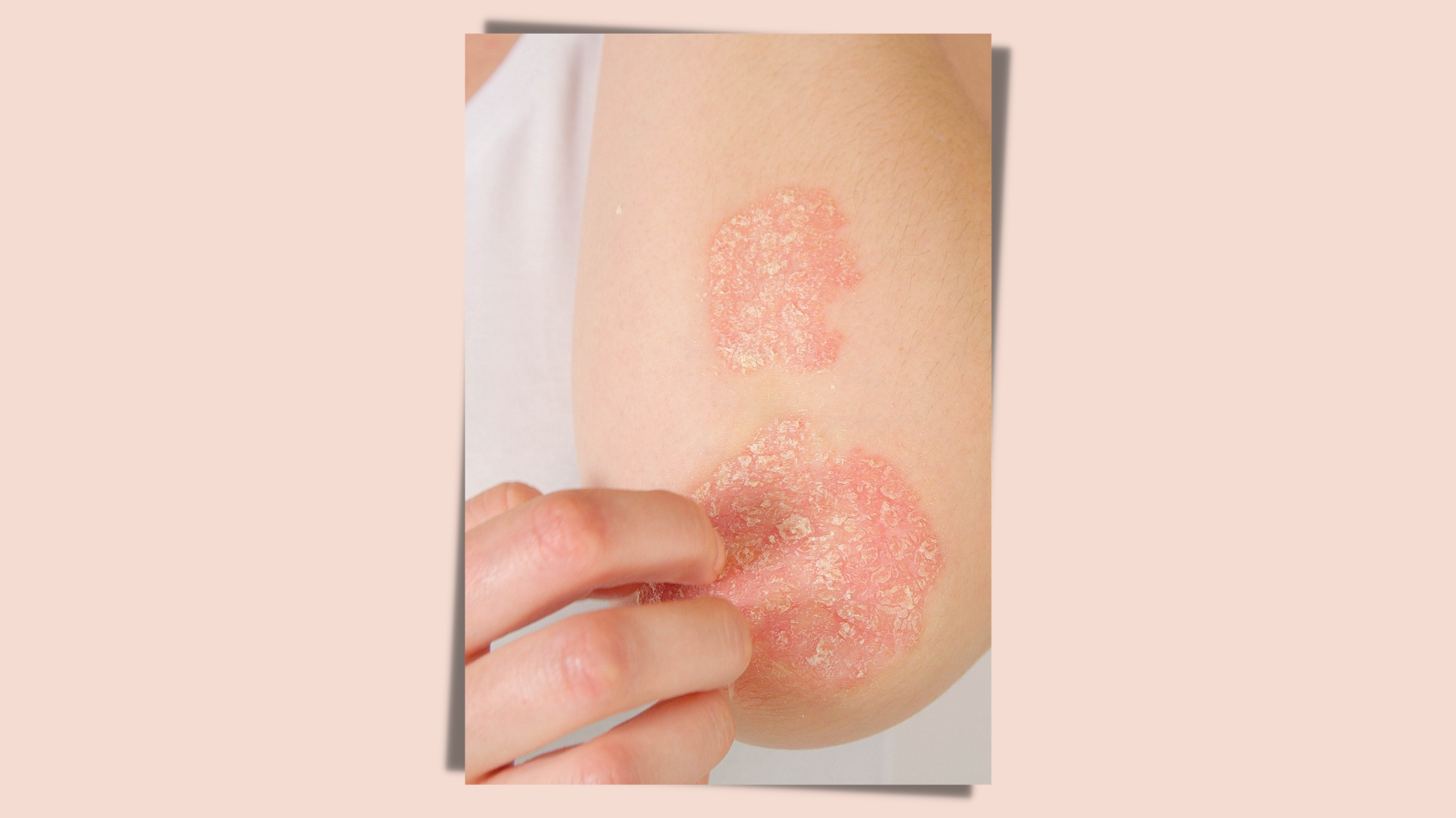 Propolis wirkt effizient gegen Schuppenflechte!