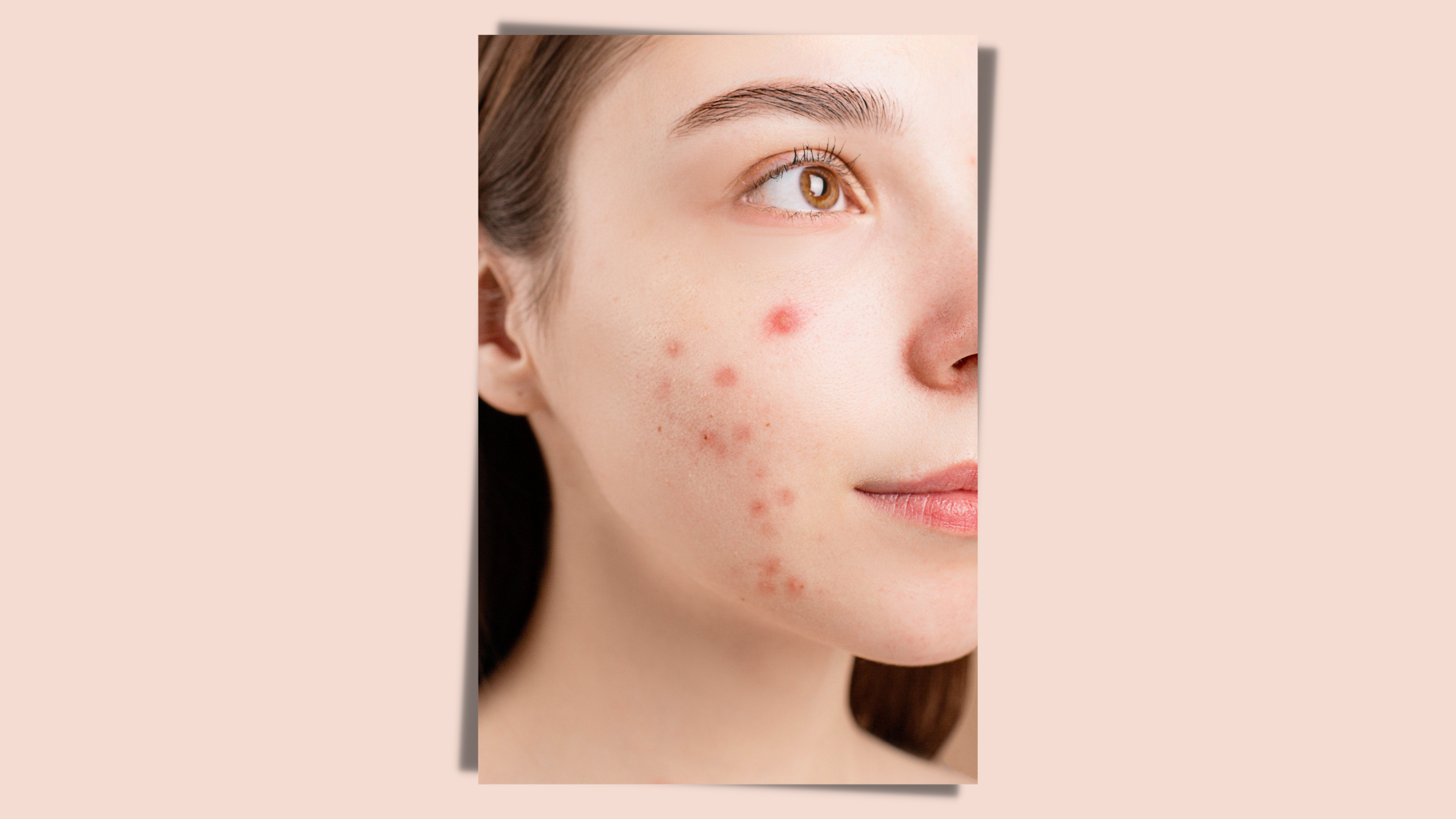 Bienengift hilft gegen Akne!